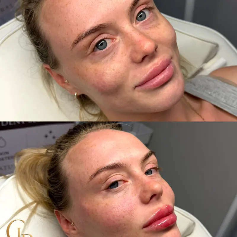 Before and after lip filler with Haus of CLB, shared with client permission