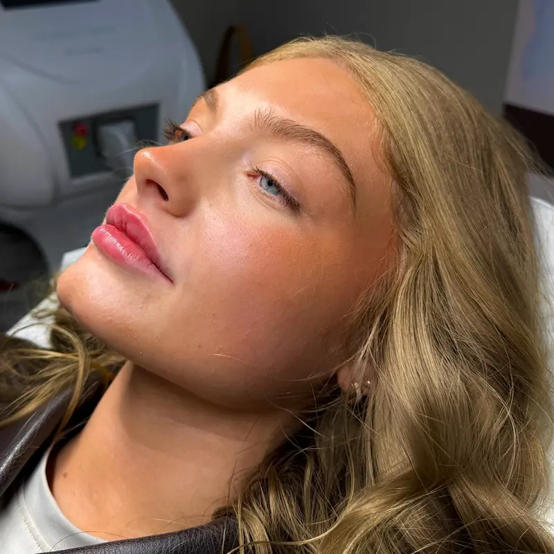 A client resting after lip filler, showing a soft, natural lip shape